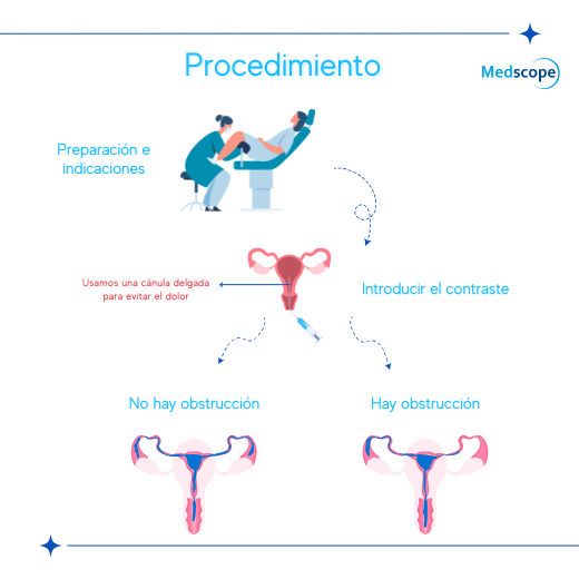 procedimiento de histerosalpingografía, mostrando la preparación, introducción del contraste y los resultados posibles: trompas sin obstrucción o con obstrucción.