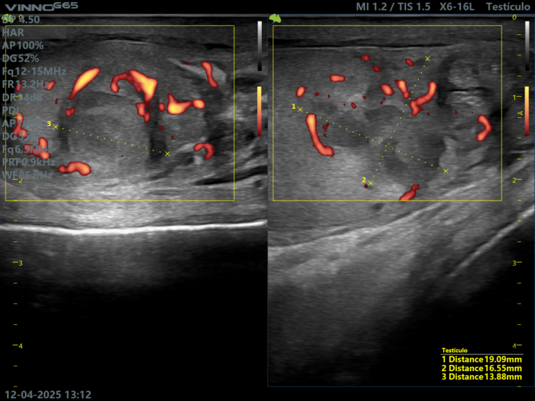 doppler testicular ecografia medico radiologo lima