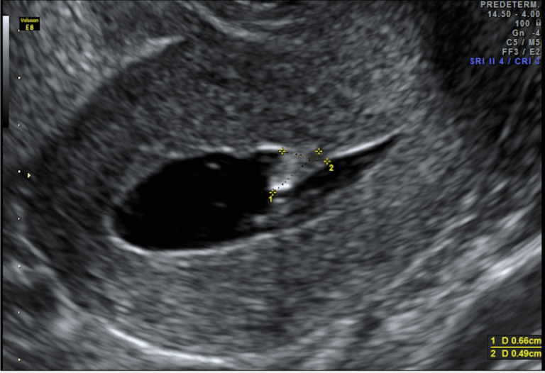 Histerosonografía en Lima Norte – Estudio de Cavidad Uterina